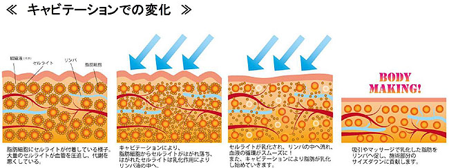 痩せる機械 キャビテーション